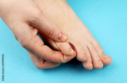 Fungus of foot close-up, isolated on blue background. The concept dermatology, treatment fungal and fungal infections in humans. Macro photograph human parasites. Rear background of a dermatologist photo