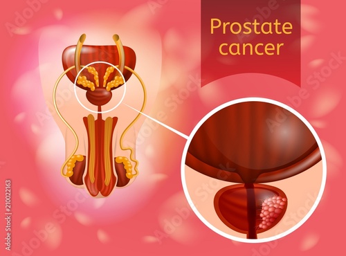 Prostate Cancer Realistic Vector Anatomical Scheme