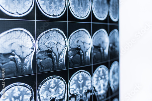 MRI scan of the head and brain of a person in the defocus