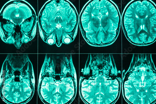 MRI scan of the head and brain of a person photo
