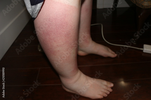 Extremely bad sunburn on legs, very swollen and possible sun poisoning photo