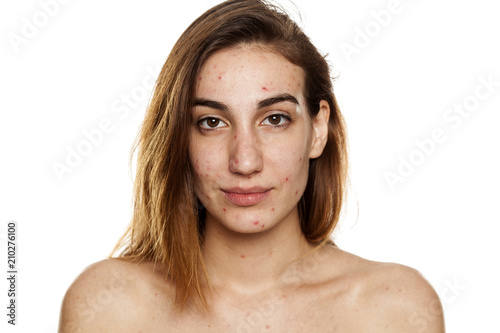 young woman with problematic skin and without makeup poses on a white background photo