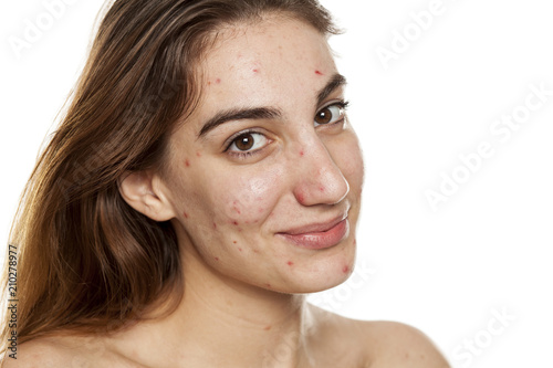 Photos young smiling woman with problematic skin and without makeup poses on a white ba