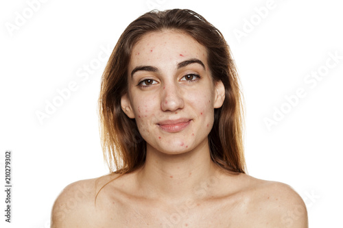 young smiling woman with problematic skin and without makeup poses on a white background photo