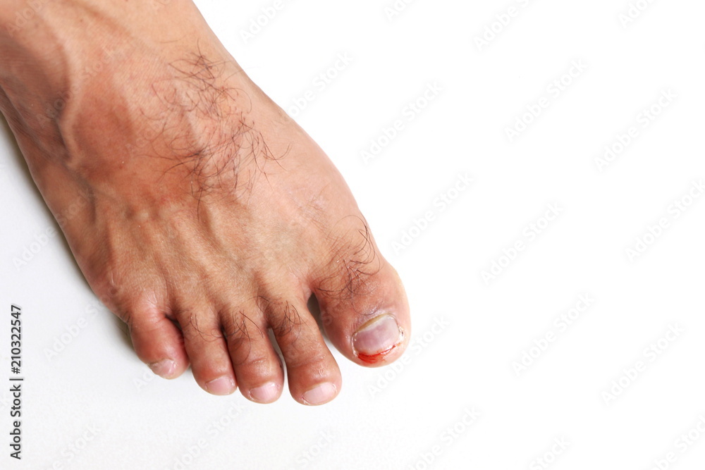 Figure out the nail, Accident nail trauma, bleeding toe nails, Foot ulcers figure out a nail, Onychocryptosis Figure out the nail, Accident nail trauma, bleeding toe nails, Foot ulcers figure out a nail, Onychocryptosis