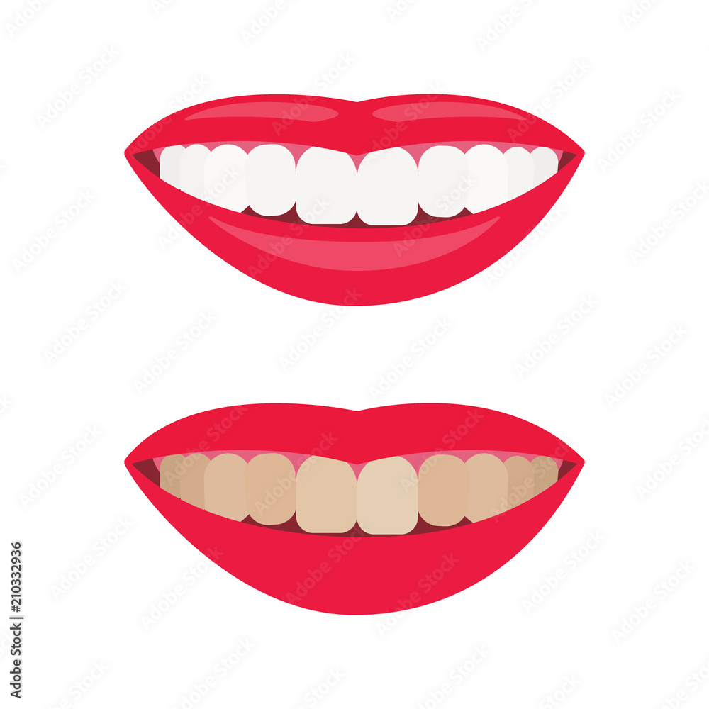 Woman smile. Comparison of smile with dirty and whitened teeth. Before and after view Woman smile. Comparison of smile with dirty and whitened teeth. Before and after view