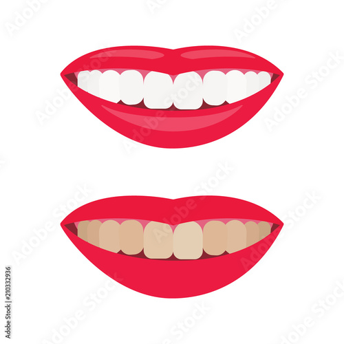 Woman smile. Comparison of smile with dirty and whitened teeth. Before and after view