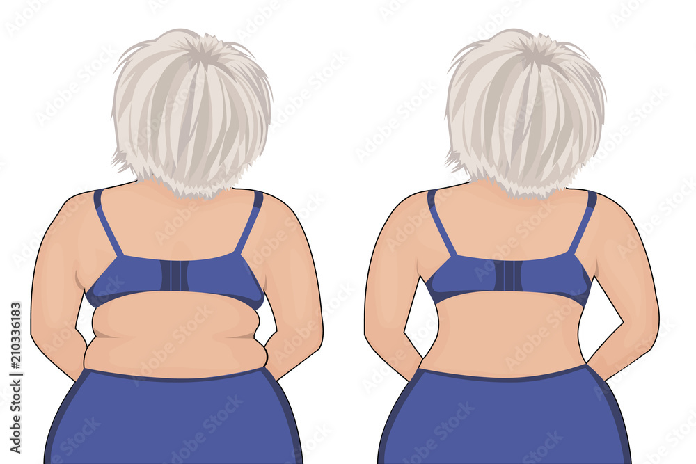 Liposuction Of Body. Slim Hips, Thin Waist. Weight Loss. Plastic Surgery  Beautiful Female Figure. Vector Illustration Royalty Free SVG, Cliparts,  Vectors, and Stock Illustration. Image 125928681.