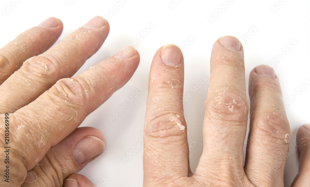 Closeup of Eczema Dermatitis on Man Hand and Fingers. Skin Peeling,desquamation  of Hand, Gray Modern Background Stock Photo - Image of atopic, condition:  184143108