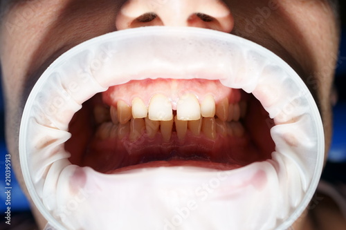 Foto dental retractor on human jaw