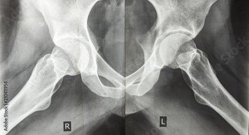 .X-ray picture of human hip joints photo