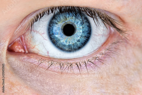 Closeup of man's red eye. Macro of conjunctivitis or irritation red bloodshot eye. Sensitive eye irritated by long work at the computer