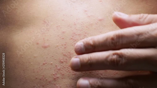 4k, a man with a naked torso scratches a red rash on his stomach. Slow motion