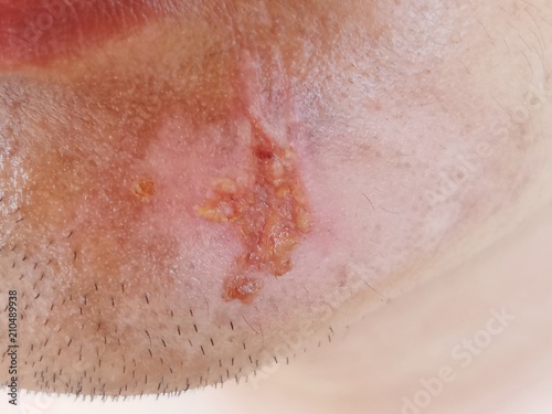 Lesion from accident on the face,Men have lesion on the chin.