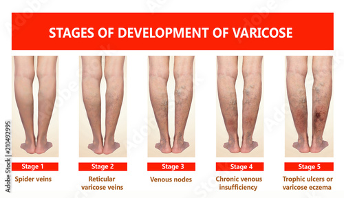 Varicose veins on a female senior leg