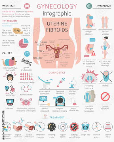 Uterine fibroids. Ginecological medical desease in women infographic photo