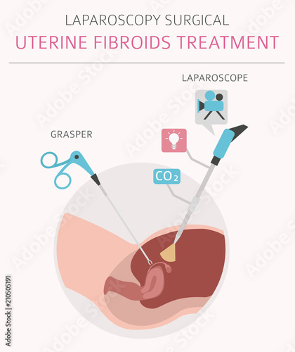 Uterine fibroids. Ginecological medical desease in women infographic