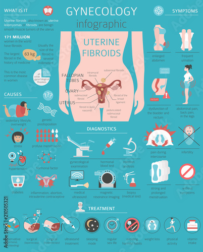 Uterine fibroids. Ginecological medical desease in women infographic