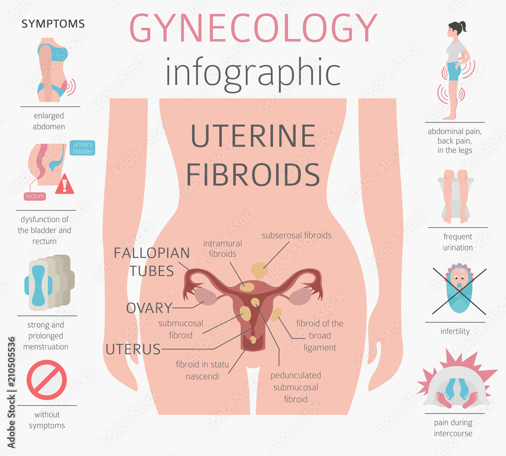 Uterine fibroids. Ginecological medical desease in women infographic ...