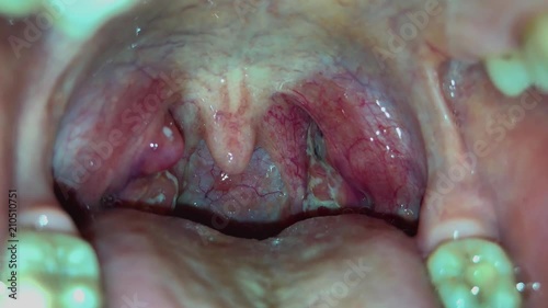 Angina, purulent tonsillitis, throat with pus on tonsils. The throat of a young girl, which is covered with white and black pus. 4k video.	 photo