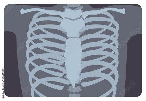 Radiograph, X-radiation picture or X-ray image of rib or thoracic cage formed by vertebral column and sternum