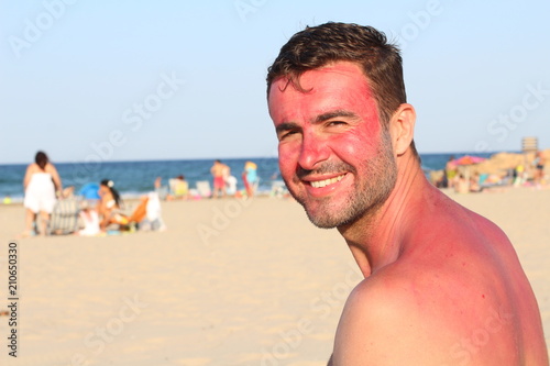Man getting sunburned at the beach 