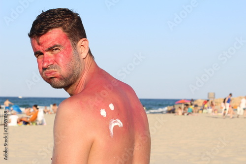 Man getting sunburned at the beach photo