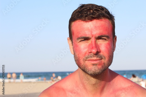Man with a major skin allergic reaction