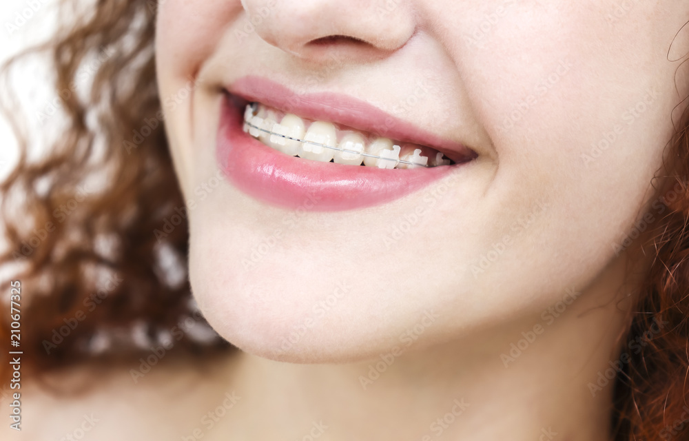 Girl in braces. Young european woman smiling in ceramic braces. Happy smile. Girl with curly red hair. Close up lips Girl in braces. Young european woman smiling in ceramic braces. Happy smile. Girl with curly red hair. Close up lips