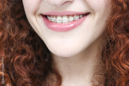 Girl in braces. Young european woman smiling in ceramic braces. Happy smile. Girl with curly red hair. Close up lips