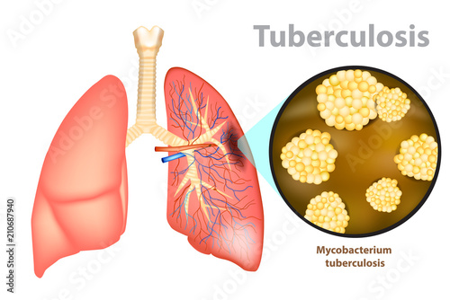 Tuberculosis is an infectious disease caused by the bacterium Mycobacterium tuberculosis. photo