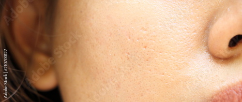 close up wide pores on oily face skin of asia woman photo