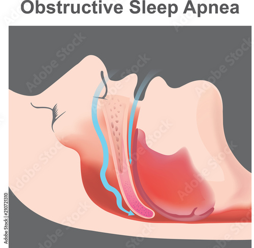 Snoring is the vibration of respiratory structures and the resulting sound due to obstructed air movement during breathing while sleeping.