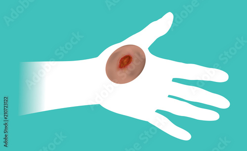 The hands that get hurt by the wound. Illustration info graphic.