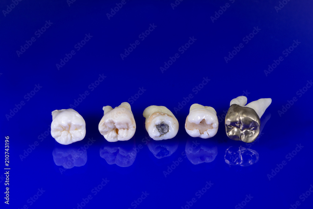 Naklejka premium der Weg der Karies von der Füllung bis zur Gusskrone