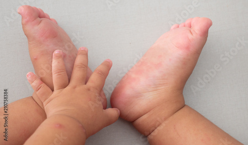 Hand, foot and mouth disease of kid photo