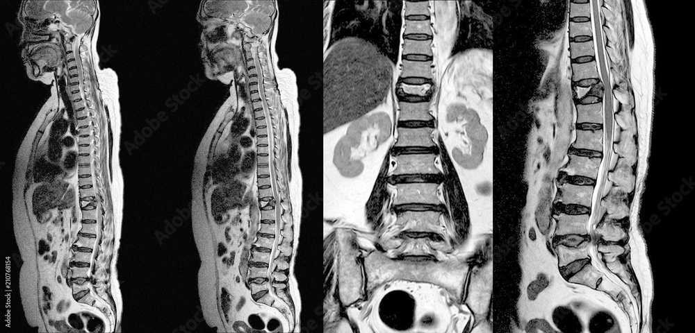 MRI of THORACOLUMBAR SPINE IMPRESSION: Moderate Pathological