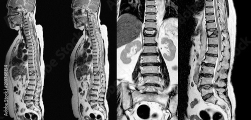 MRI THORACIC-LUMBAR Spine:Moderate pathological compression fracture of T12 level vertebral body. photo