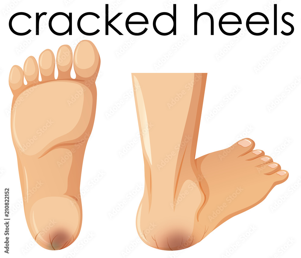 A Set of Human Foot with Cracked Heels A Set of Human Foot with Cracked Heels