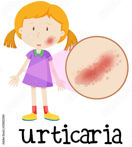 A Girl with Urticaria on Skin