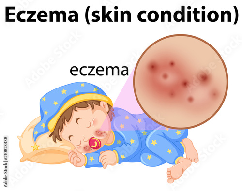 A Baby Having Eczema on Face