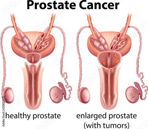 Comparison of Healthy and Cancer Prostate