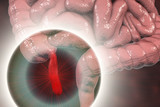 Acute appendicitis, 3D illustration showing inflammed appendix on the cecum