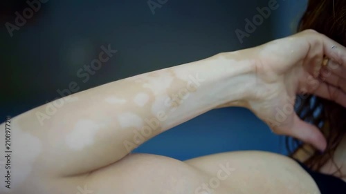 adult brown-haired woman is showing and demonstrating her vitiligo patches on skin of arms, lifting hands up photo