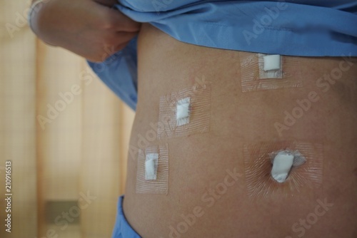 An abdomen of adult Asian female patient with Waterproof Transparent Dressing after Cholecystectomy or Laparoscopic Gallbladder Surgery for gallstones removal.