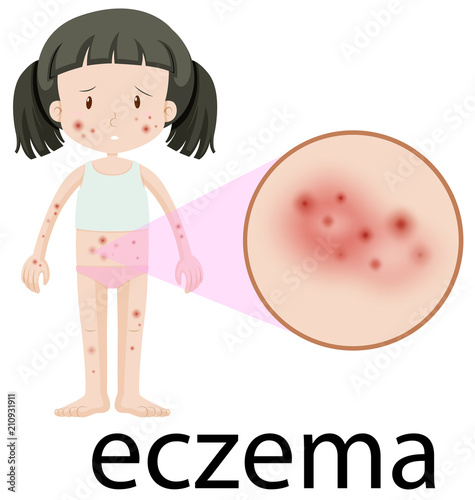 A Girl with Eczema on White Background