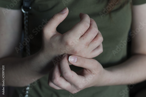 Skin allergy. Itchy hands with scabies. Dermatology problem eczema