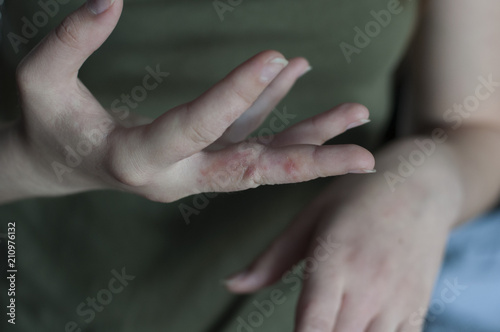 Pain in hands. Sore at woman hand. Scabies in macro, itchy fingers photo