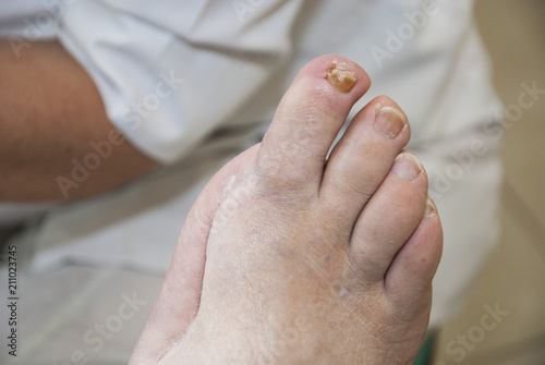 Podiatry. Diabetic foot. Foot Podiatrist