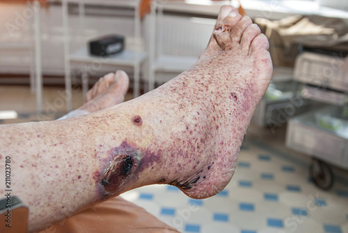 Hemorrhagic vasculitis. Ulcer on the skin of the foot. photo